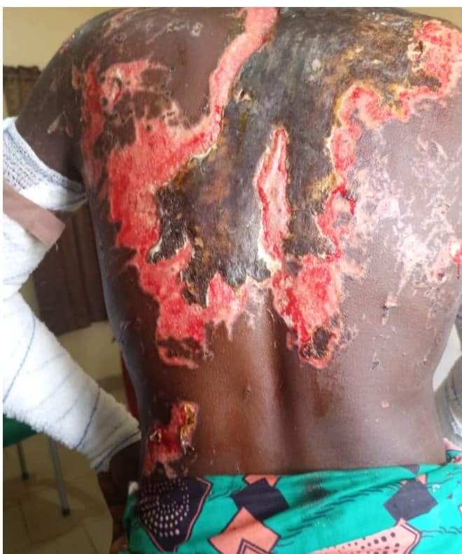 POLICE REOPENS ACID BATH CASE FOR INVESTIGATION IN ADAMAWA